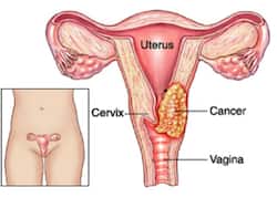 Cervical Cancer: 4th Most Frequent Malignancy Among Women Worldwide