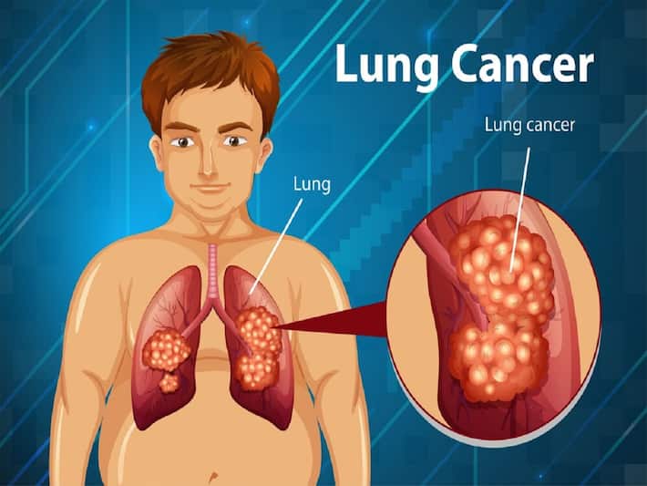 Lung Cancer Symptoms 