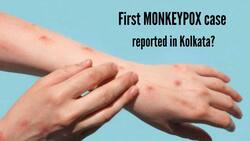 Monkeypox Reaches India? outh With Monkeypox-Like Symptoms Admitted To Hospital In Kolkata
