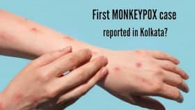 Monkeypox Reaches India? outh With Monkeypox-Like Symptoms Admitted To Hospital In Kolkata