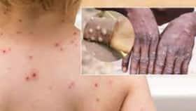 Monkeypox Cases On The Rise: Indian Union Health Ministry Issues New Guidelines