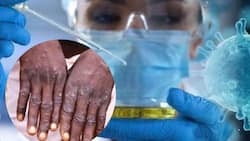 इस वजह से भारत में लोग नहीं कराते मंकीपॉक्स टेस्ट