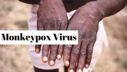 New Symptoms Of Monkeypox Found In Infected Patients In The UK