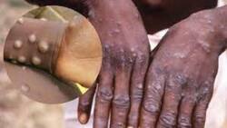 First Monkeypox Death In India: Kerala Youth Had Tested Positive Abroad, Probe Ordered