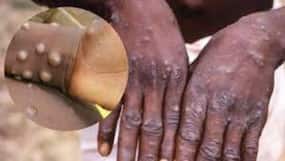First Monkeypox Death In India: Kerala Youth Had Tested Positive Abroad, Probe Ordered