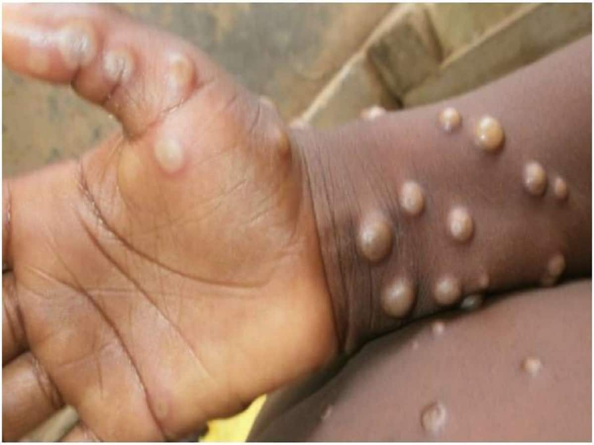 What does monkeypox look like? What to know as Toronto finds new cases