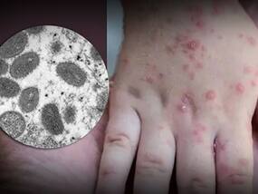 WHO Announces New Names Of Monkeypox Virus Variants