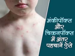 एक जैसे होते हैं मंकीपॉक्स और चिकनपॉक्स के कुछ लक्षण, इन एक्सपर्ट टिप्स की मदद से समझे दोनों में अंतर