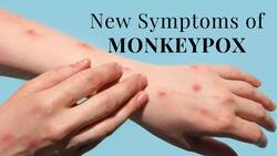 New Symptoms of Monkeypox: 3 Severe Symptoms To Watch Out For