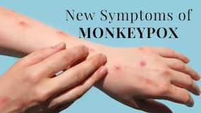 New Symptoms of Monkeypox: 3 Severe Symptoms To Watch Out For