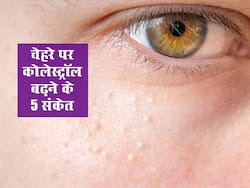 हाई कोलेस्ट्रॉल के संकेत हो सकते हैं चेहरे में दिखने वाले ये 5 बदलाव, जानें और ना करें नजरअंदाज