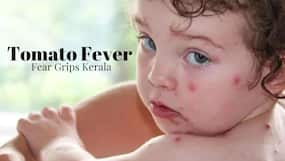 Tomato Fever Fear Grips Kerala: 5 Tips To Protect Your Kids From Catching The Virus Infection