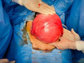 Giant Pumpkin-Size Fibroid Removed From a Woman   s Uterus in Pune: Do Not Ignore These Signs And Symptoms