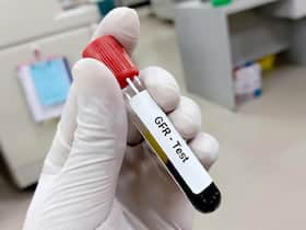 Regular Check-Ups Can Prevent Progression Of Chronic Kidney Disease: How Frequently Should You Get Checked?