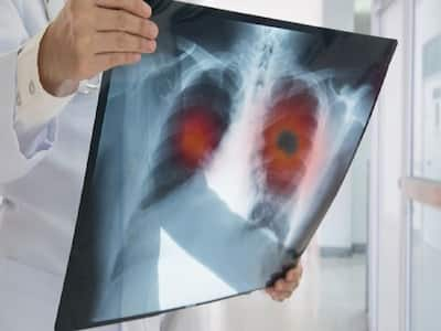 World Lung Cancer Day: Why Lung Cancer In Non-Smokers Is On The Rise?