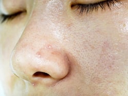 Oily Skin? Try These 7 Natural Remedies At Home