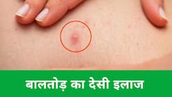 Home Remedies: बालतोड़ के दर्द से कैसे पाएं निजात करें ये घरेलू उपचार मिलेगा भरपूर आराम, Watch Video