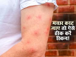 Mosquito bite marks : बच्चा हो या बूढ़ा इन 7 नुस्खों से ठीक करें मच्छर के काटे का निशान! खुजली और पित्त से मिलेगी राहत