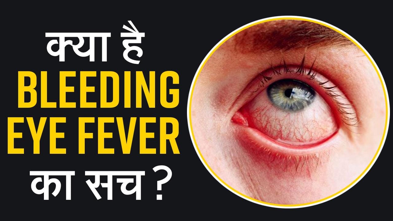 Bleeding Eye Fever आखों में दिख रहे हैं यह लक्षण तो हो जाएं सावधान