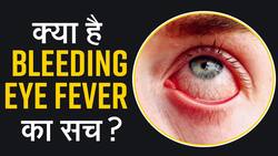 Bleeding Eye Fever: आखों में दिख रहे हैं यह लक्षण तो हो जाएं सावधान, तुरंत करें इसका इलाज, Watch Video