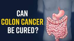 Colon Cancer: Know The Signs, Stages and Treatment for Colon Cancer, Watch Video
