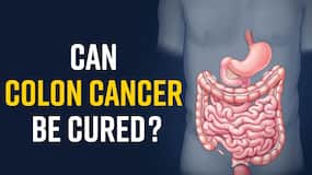 Colon Cancer: Know The Signs, Stages and Treatment for Colon Cancer, Watch Video
