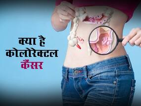 कोलोरेक्टल कैंसर: आंतों से शुरू हो कर मलाशय तक फैल जाता है ये कैंसर, जानें इसके 7 शुरुआती संकेत कोलोरेक्टल कैंसर: आंतों से शुरू हो कर मलाशय तक फैल जाता है ये कैंसर, जानें इसके 7 शुरुआती संकेत