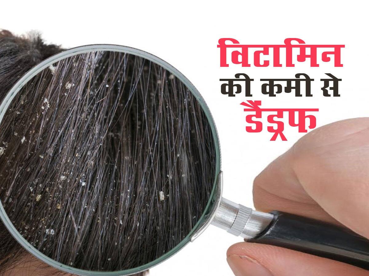 इन 3 विटामिन की कमी वाले लोगों में ज्यादा होता है डैंड्रफ, जानें बचाव
