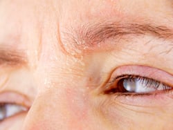Eyebrows Can Have Dandruff Too: Know How It Happens