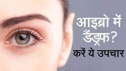 Dandruff Home Remedies: आइब्रो का डैंड्रफ होगा दूर, अपनाएं यह घरेलू नुस्खे, Watch Video