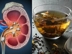 Gokshura Benefits For Kidney Stone: किडनी स्टोन के लिए बेस्ट है ये हर्बल वॉटर, डॉक्टर ने बताया इसे पीने का तरीका