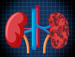 किडनी के लिए सबसे बेकार माने जाते हैं ये 5 फूड, गुर्दे में संक्रमण होने पर भूल कर भी न करें इनका सेवन