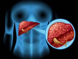 World Hepatitis Day 2022: Dietary Recommendations For A Healthy Liver