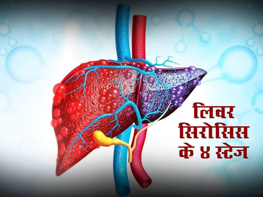 लिवर सिरोसिस की शुरुआत कैसे होती है? जानें सूजन से लेकर लिवर फेलियर तक इसके 4 स्टेज
