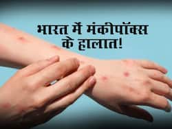 40 देशों के बाद भारत में मंकीपॉक्स का पहला मामला! जानें अब तक किस देश में सबसे ज्यादा मामले