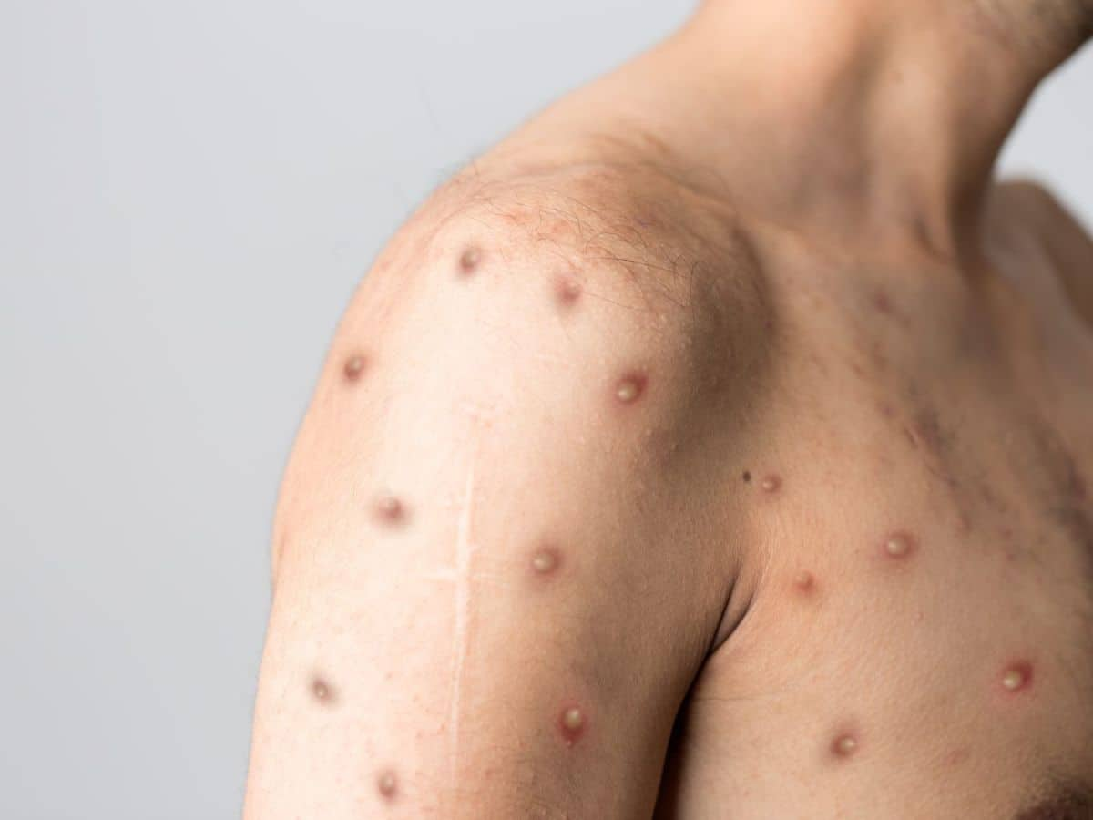 chickenpox-facts-diseases-of-the-world-worldatlas