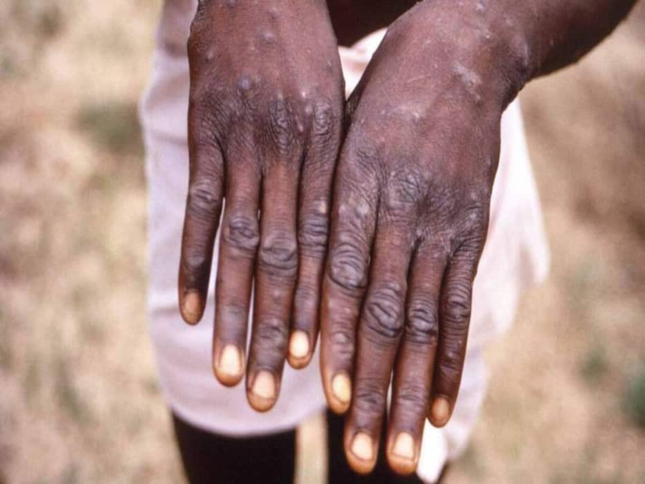 From Monkeypox To Mosquito-Borne Diseases: Health Diseases Spreading Rapidly In India