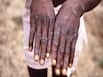 Does Monkeypox Spread Faster Than Coronavirus? Here's What WHO Says