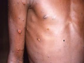 Monkeypox News: Canada, Argentina Report New Cases, USA Unveils Ambitious Vaccination Plan