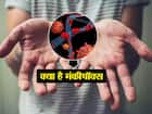 मंकीपॉक्स (Monkeypox)