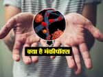 मंकीपॉक्स (Monkeypox)