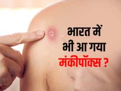 कोलकाता के एक छात्र में मंकीपॉक्स के लक्षण दिखने से देश में हड़कंप, पुष्टि के लिए NIV को भेजी गई रिपोर्ट