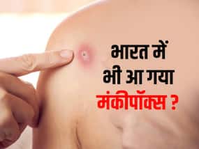 कोलकाता के एक छात्र में मंकीपॉक्स के लक्षण दिखने से देश में हड़कंप, पुष्टि के लिए NIV को भेजी गई रिपोर्ट