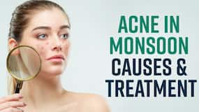 Monsoon Skin Care: How To Treat Acne At Home During Monsoon Season, Watch Video Monsoon Skin Care: How To Treat Acne At Home During Monsoon Season, Watch Video