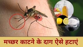 Mosquito Bite: मच्छरों काटे के निशानों को हटाने के लिए अपनाएं यह घरेलू उपाय, Watch Video Mosquito Bite: मच्छरों काटे के निशानों को हटाने के लिए अपनाएं यह घरेलू उपाय, Watch Video