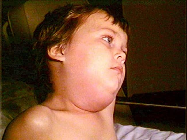 mumps