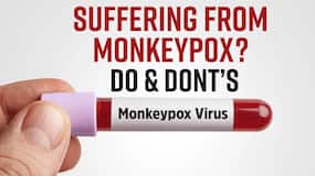 Monkeypox Outbreak: Know The Early Signs And Symptoms Of Monkeypox, Watch Video