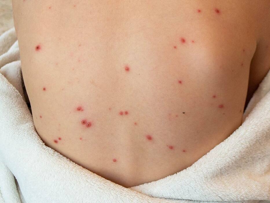 From Monkeypox To Mosquito-Borne Diseases: Health Diseases Spreading Rapidly In India