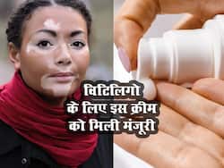 FDA ने विटिलिगो के इस क्रीम को दी मंजूरी, जानें क्या है इस दवा की खासियत
