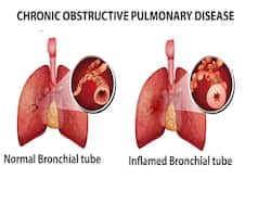 5 Facts About Chronic Obstructive Pulmonary Disease (COPD) That You May Not Know
